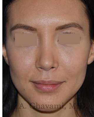 Rhinoplasty Before & After Patient #6919