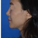 Rhinoplasty Before & After Patient #6919