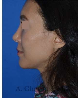 Rhinoplasty Before & After Patient #6919