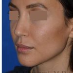 Rhinoplasty Before & After Patient #6919