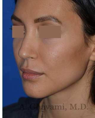 Rhinoplasty Before & After Patient #6919