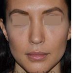 Rhinoplasty Before & After Patient #6919