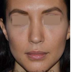 Rhinoplasty Before & After Patient #6919