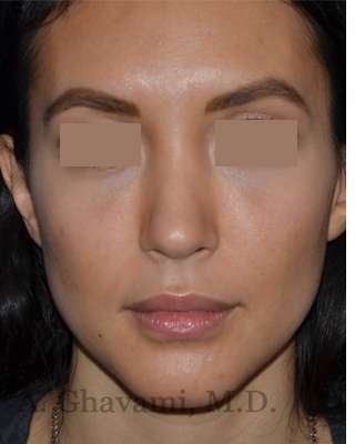 Rhinoplasty Before & After Patient #6919