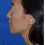 Rhinoplasty Before & After Patient #6919