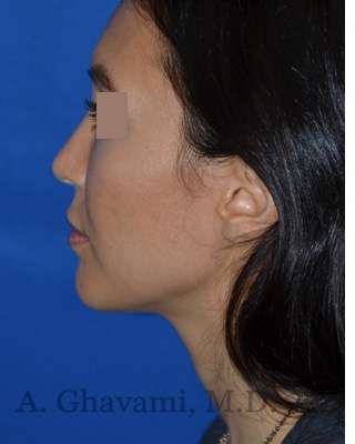 Rhinoplasty Before & After Patient #6919