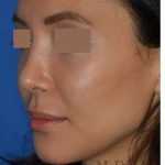 Rhinoplasty Before & After Patient #6919