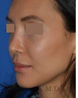Rhinoplasty Before & After Patient #6919