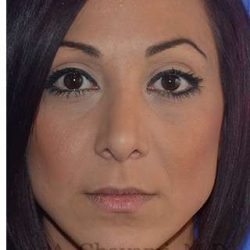 Ethnic Rhinoplasty Before & After Patient #6912