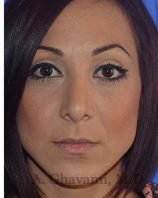Ethnic Rhinoplasty Before & After Patient #6912