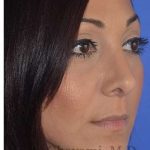 Ethnic Rhinoplasty Before & After Patient #6912