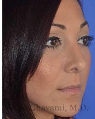 Ethnic Rhinoplasty Before & After Patient #6912