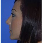 Ethnic Rhinoplasty Before & After Patient #6912