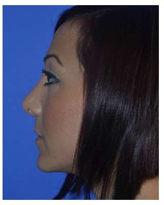 Ethnic Rhinoplasty Before & After Patient #6912