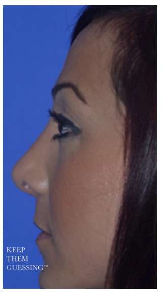 Ethnic Rhinoplasty Before & After Patient #6912