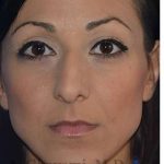 Ethnic Rhinoplasty Before & After Patient #6912
