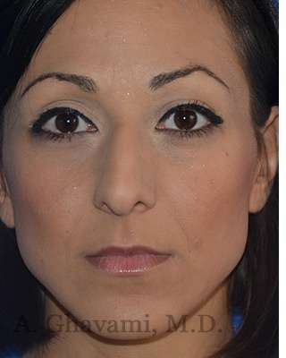 Ethnic Rhinoplasty Before & After Patient #6912