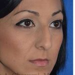 Ethnic Rhinoplasty Before & After Patient #6912