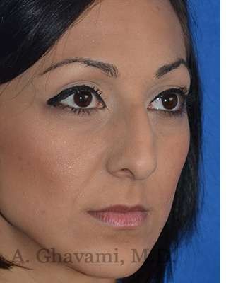 Ethnic Rhinoplasty Before & After Patient #6912