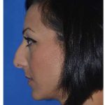 Ethnic Rhinoplasty Before & After Patient #6912
