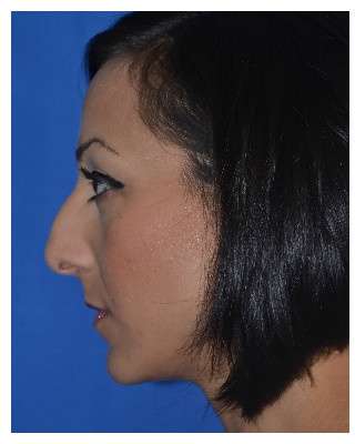 Ethnic Rhinoplasty Before & After Patient #6912