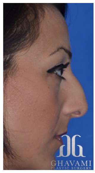 Ethnic Rhinoplasty Before & After Patient #6912
