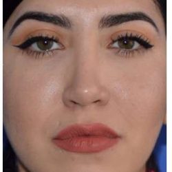 Ethnic Rhinoplasty Before & After Patient #6903