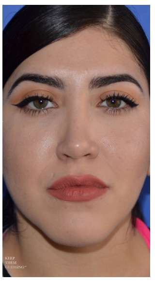 Ethnic Rhinoplasty Before & After Patient #6903