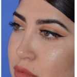 Ethnic Rhinoplasty Before & After Patient #6903