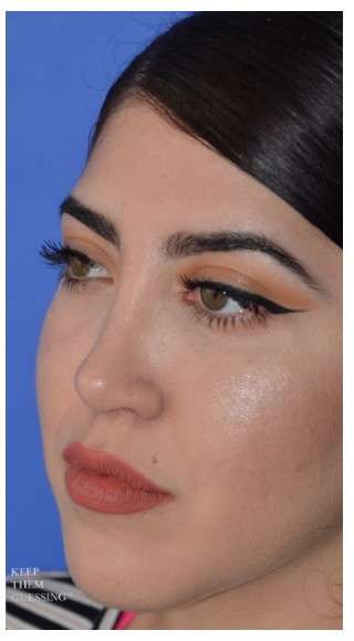 Ethnic Rhinoplasty Before & After Patient #6903