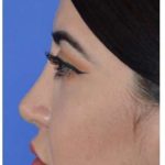 Ethnic Rhinoplasty Before & After Patient #6903