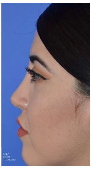 Ethnic Rhinoplasty Before & After Patient #6903