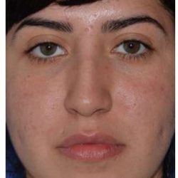 Ethnic Rhinoplasty Before & After Patient #6903