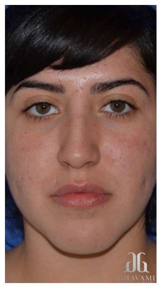 Ethnic Rhinoplasty Before & After Patient #6903