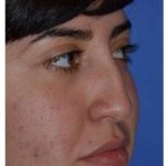 Ethnic Rhinoplasty Before & After Patient #6903