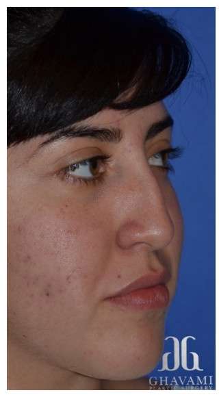 Ethnic Rhinoplasty Before & After Patient #6903