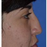 Ethnic Rhinoplasty Before & After Patient #6903