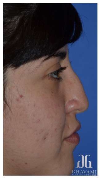 Ethnic Rhinoplasty Before & After Patient #6903