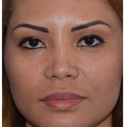 Ethnic Rhinoplasty Before & After Patient #6889