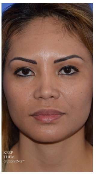 Ethnic Rhinoplasty Before & After Patient #6889
