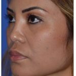 Ethnic Rhinoplasty Before & After Patient #6889
