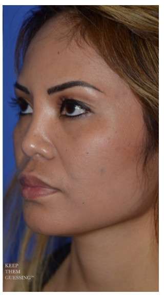Ethnic Rhinoplasty Before & After Patient #6889