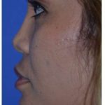Ethnic Rhinoplasty Before & After Patient #6889