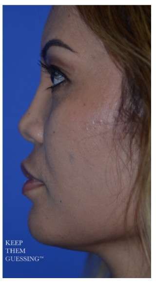Ethnic Rhinoplasty Before & After Patient #6889