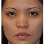 Ethnic Rhinoplasty Before & After Patient #6889