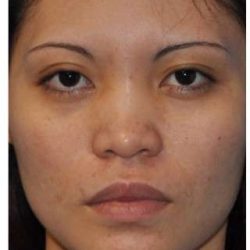 Ethnic Rhinoplasty Before & After Patient #6889