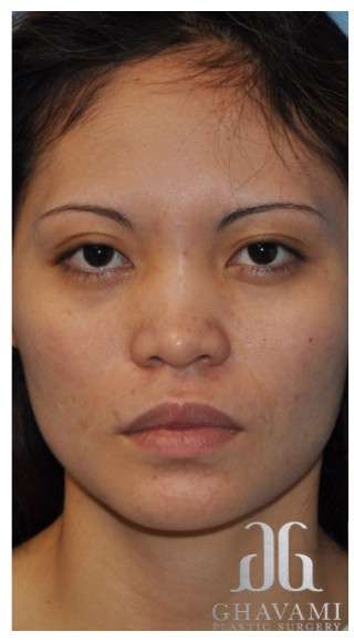 Ethnic Rhinoplasty Before & After Patient #6889