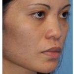 Ethnic Rhinoplasty Before & After Patient #6889