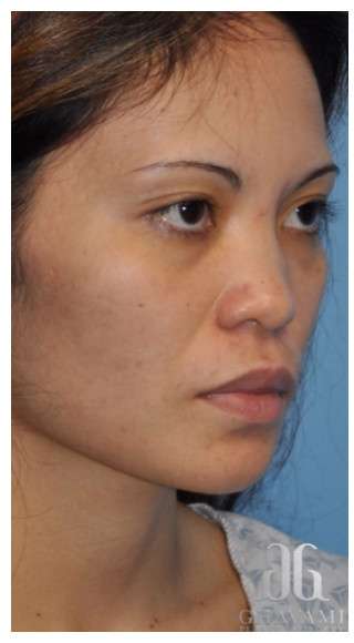Ethnic Rhinoplasty Before & After Patient #6889