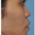 Ethnic Rhinoplasty Before & After Patient #6889